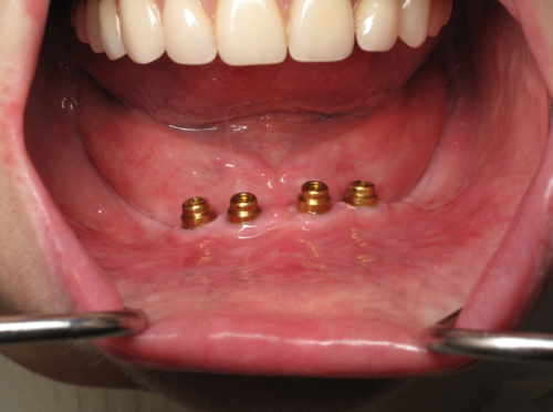 denture implants Arlington TX