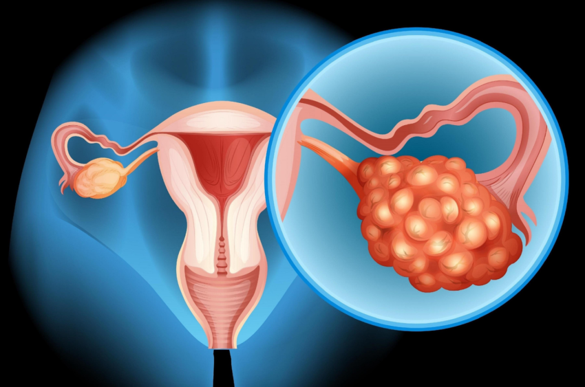 Post-Treatment Care and Monitoring by Ovarian Cancer Specialists in Mumbai