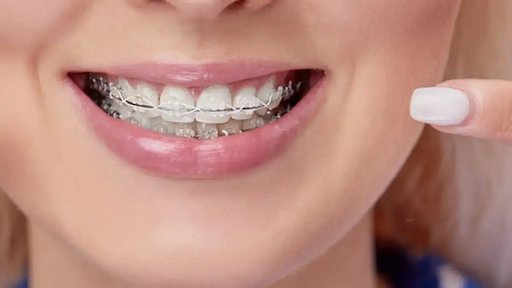 Modern Smile Alignment: Understanding Self-Locking Braces Care